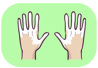 Hands Symptom Loss Of Pigment In Skin Illustration