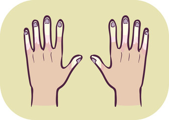 Hands Symptom Raynauds Phenomenon Illustration