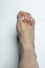 ill, injured toe, yellow nails in a damaged, feminine foot isolated on a white background