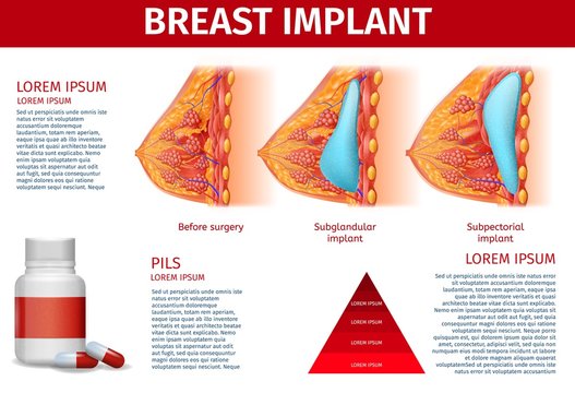 Breast Implant Anatomical Banner, Copy Space.