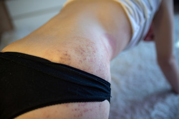  A bruise on the body of a young girl, a woman with extensive hematoma after a massage, isolated on...