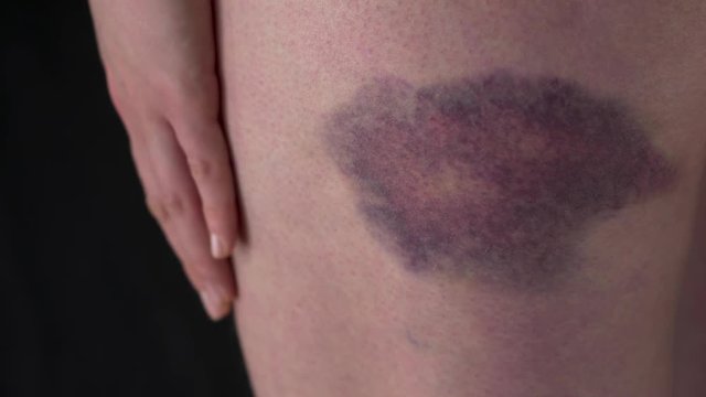 Big Bruise On Female Body