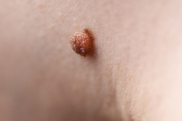 Unrecognizable person having dark fibroma, dermatology problem on skin. Close up of papilloma...