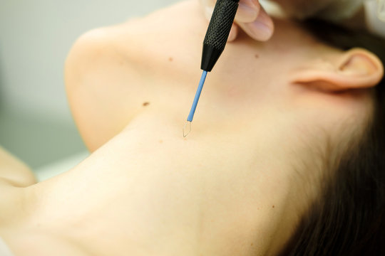 Medical treatment removal of birthmark from female patient's neck. Female dermatologist surgeon using electrocautery for removing mole. Radio wave electrocoagulation remove method. Close up