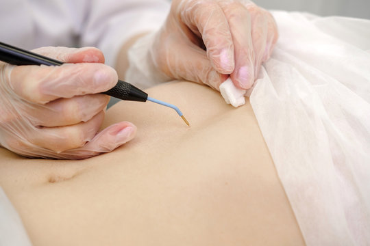 Medical treatment removal of birthmark from female patient's stomach. Female dermatologist surgeon using electrocautery for removing mole on belly. Radio wave electrocoagulation remove method