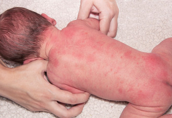 Newborn with easy baby acne on the body, possibly from an adverse reaction to shots given at birth...