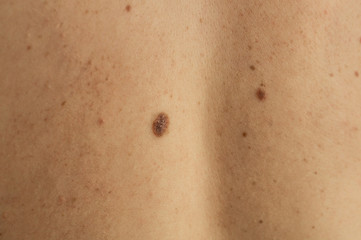 Fototapeta premium Close up detail of the bare skin on a man back with scattered moles and freckles. Checking benign moles. Sun effect on skin. Birthmarks on skin