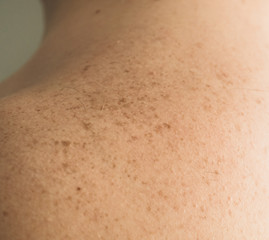 Fototapeta premium Close up detail of the bare skin on a man back with scattered moles and freckles. Checking benign moles. Sun effect on skin. Birthmarks on skin