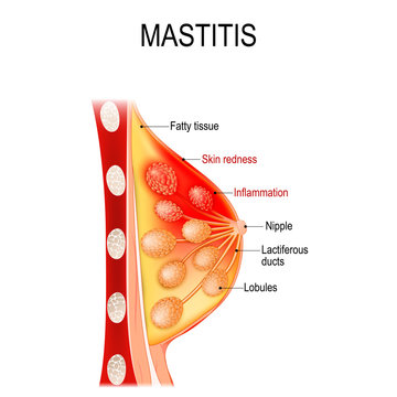 Mastitis. Cross-section of the mammary gland with inflammation of the breast (abscess formation).