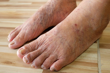 Close up varicose veins on the legs and feet of an Asian old woman