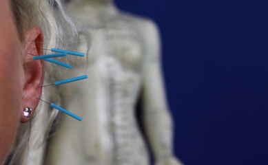 Close up of human female ear with blue needles: Ear acupuncture as a form of alternative chinese...