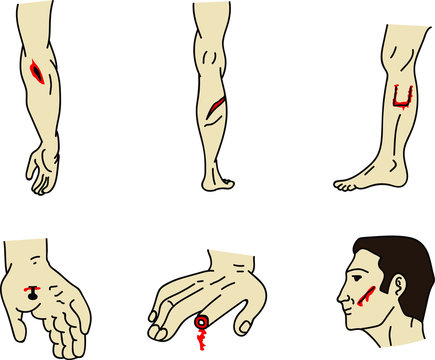 Clasificaci&oacute;n de heridas