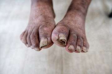 Fototapeta na wymiar The old man foot very dirty