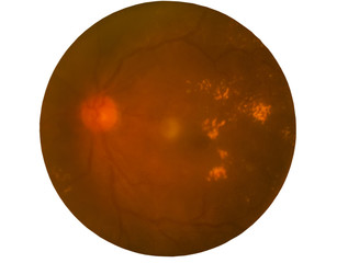 Retina of diabetes , diabates retinopathy,photo Medical Retina Abnormal (cataract) isolated on white background.Saved with clipping path
