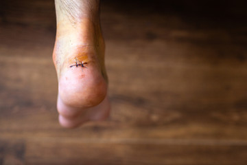 Injured and swollen ankle with stitched up wound