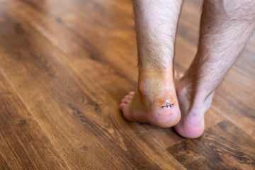 Injured and swollen ankle with stitched up wound isolated against wooden background