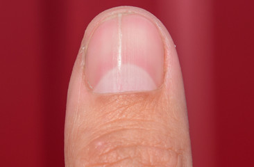 Forked nail on the thumb. Dilation of the nail, traumatic pathology. The nail is divided in half