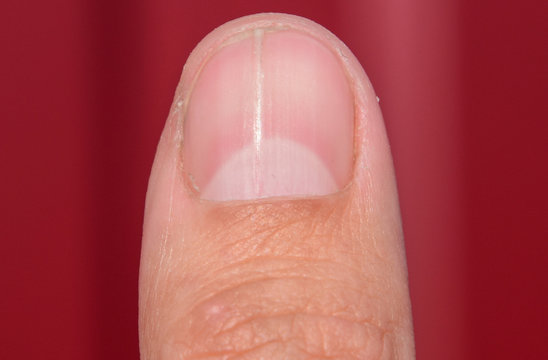 Forked nail on the thumb. Dilation of the nail, traumatic pathology. The nail is divided in half