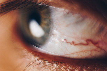 macro eyes with bursting red blood vessels. eyeball covered with blood close up. vision problems.