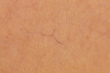 Fototapeta premium Ski with dilated capillaries ad red spots