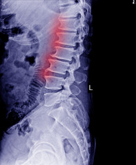 Lumbar spine x-ray show spur of vertebral body.