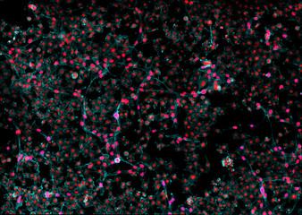 Real fluorescence microscopic view of cancer cells - human melanoma