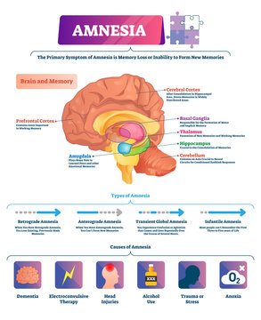 Amnesia vector illustration. Labeled brain memory loss disease types scheme