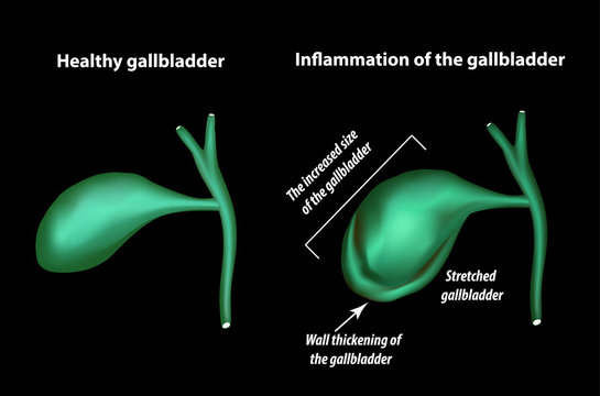 Symptoms of gallbladder inflammation. Cholecystitis. Thickening of the gallbladder wall. Increased gall bladder. Infographics. Vector illustration