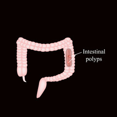Polyp in the intestine. Polyp in the colon. Vector illustration on a black background