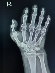Film x-ray wrist (AP, view) : Old fracture distal radius