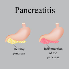 Inflammation of the pancreas. Pancreatitis. Vector illustration on a gray background