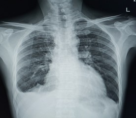 Film x-ray wrist (AP, view) : Old fracture distal radius