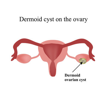 Dermoid cyst on the ovary. . Infographics. Vector illustration  isolated background