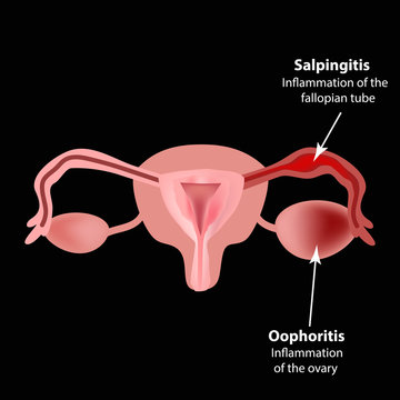 Salpingitis. Inflammation of the fallopian tube. Oophoritis.   the ovary. pelvic organs. Infographics Vector illustration