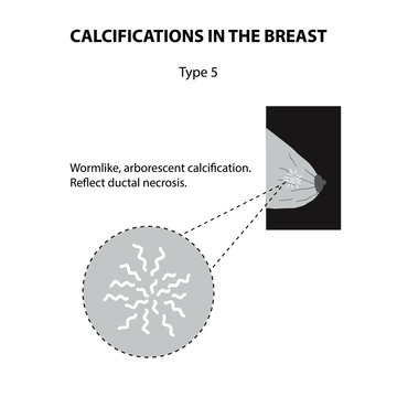 Calcifications in the breast. Mammography. The mammary gland. Infographics. Vector illustration on isolated background