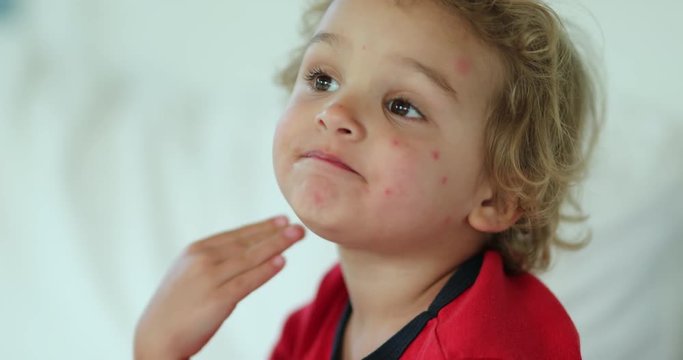 Child covered with mosquito bites, chewing food