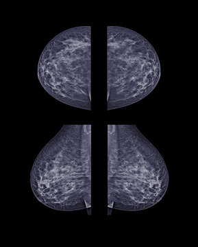  X-ray Digital Mammogram  or mammography  both side of the breast  CC view and MLO  for finding Breast cancer in women . Clipping path.
