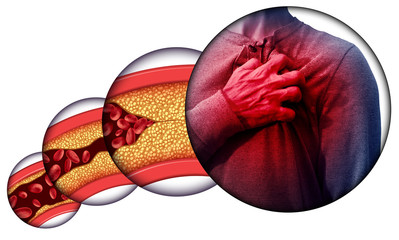 Human Heart Disease - obrazy, fototapety, plakaty