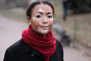 A beautiful young girl of African ethnicity with vitiligo standing on the warm spring city street...