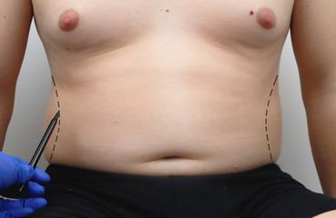 Tummy tuck, liposuction, breast surgery. A plastic surgeon prepares a man for plastic surgery.