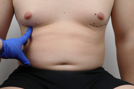 Tummy tuck, liposuction, breast surgery. A plastic surgeon prepares a man for plastic surgery.