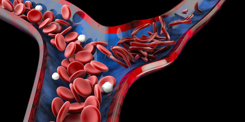 Sickle cell anemia, showing blood vessel with normal and deformated crescent. 3D illustration - obrazy, fototapety, plakaty