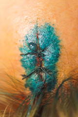 Head wound after a car accident. Brilliant green solution on the forehead. Head injury. Wound...