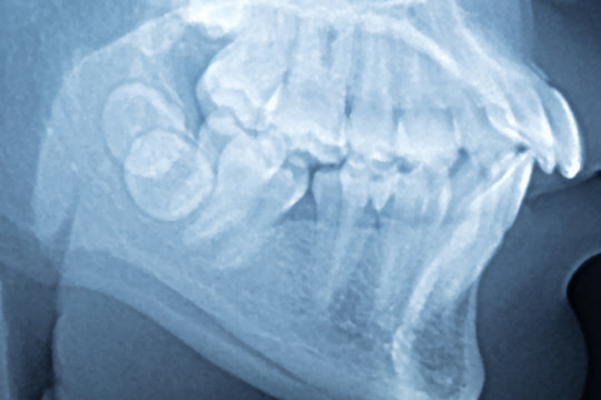 Close up panoramic dental x-ray of a mouth.