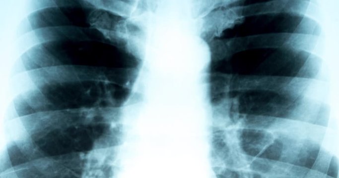 X-ray of the chest, ribs close-up