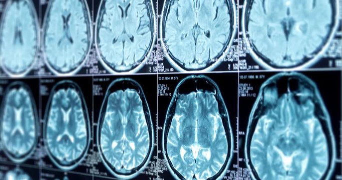 MRI scan of the brain close up scroll up, looped