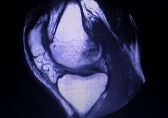 MRI knee meniscus tear scan