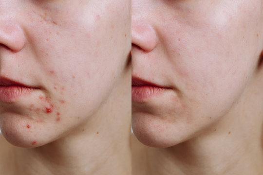 Young woman before and after acne treatment, closeup. Skin care concept