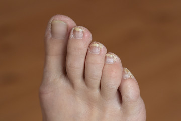 Closeup ingrown nail at the big toe of a man isolated on white background.