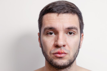 Obraz premium Herpes on lips of the young man. Inflammation of the lip. Beautiful lips infected herpes virus.